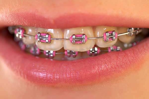 Conventional Orthodontics