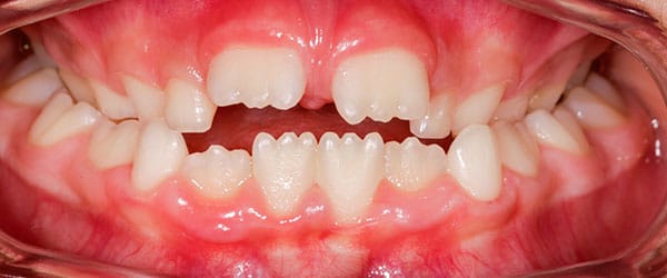 Braces to correct underbite