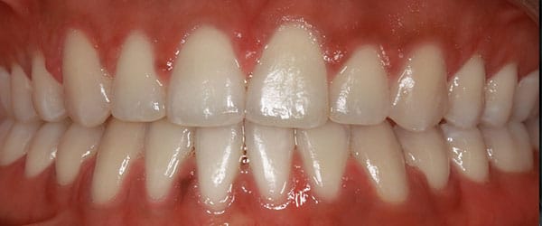 Gaps between teeth