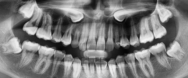 Gaps between teeth