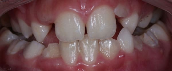 Braces to correct excessive crowding