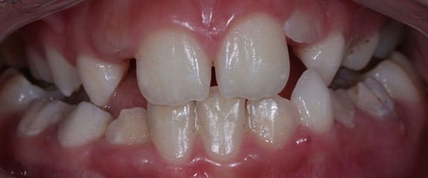 Braces to correct excessive crowding