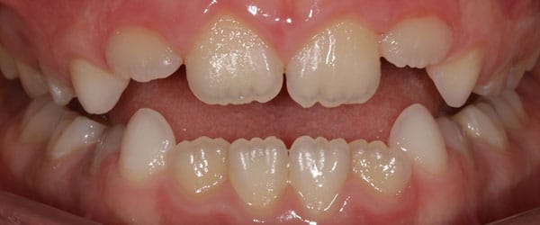 Braces to correct space between upper and lower teeth