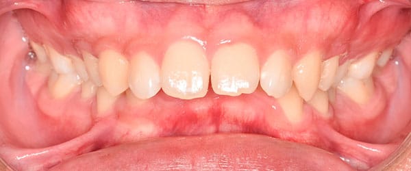 Metal braces to correct overbite