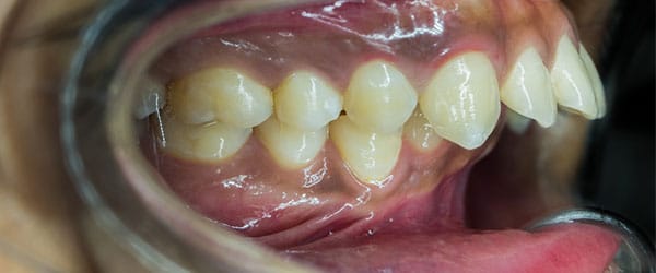 Gaps between teeth