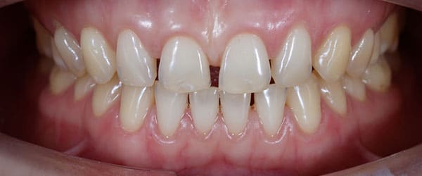 Gaps between teeth