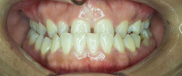 Braces to correct alignment of upper and lower teeth